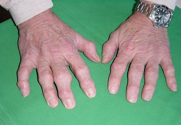 Artrose van de vingers
