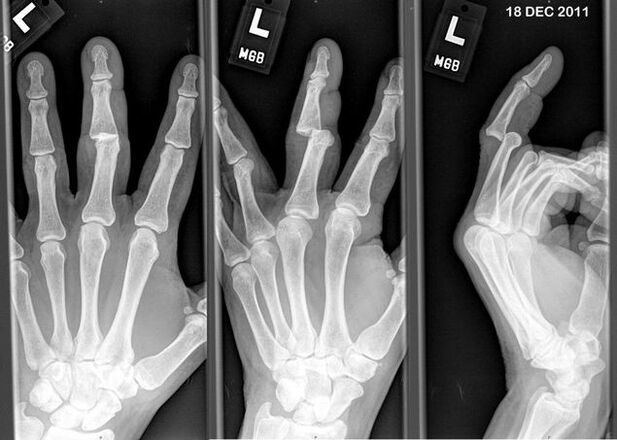 Röntgenfoto van de ontwrichte vingers