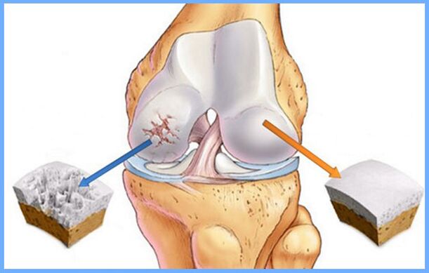 Normaal kniegewricht en aangetast door artrose