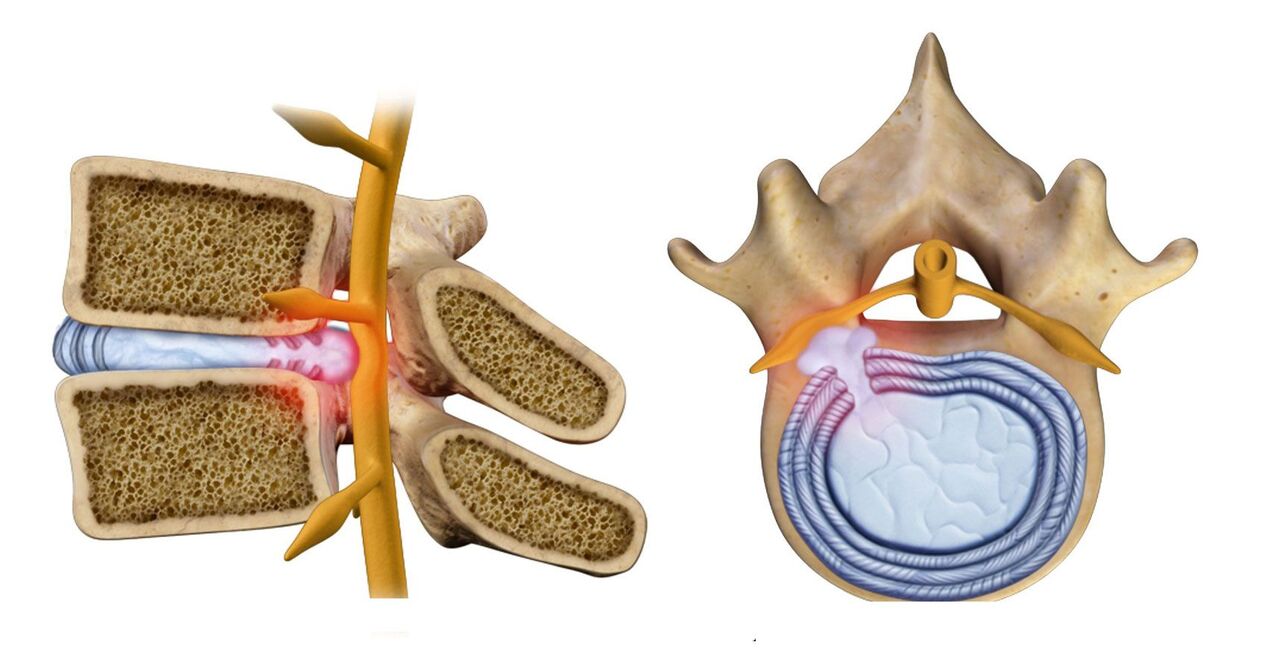 spinale hernia bij thoracale osteochondrose