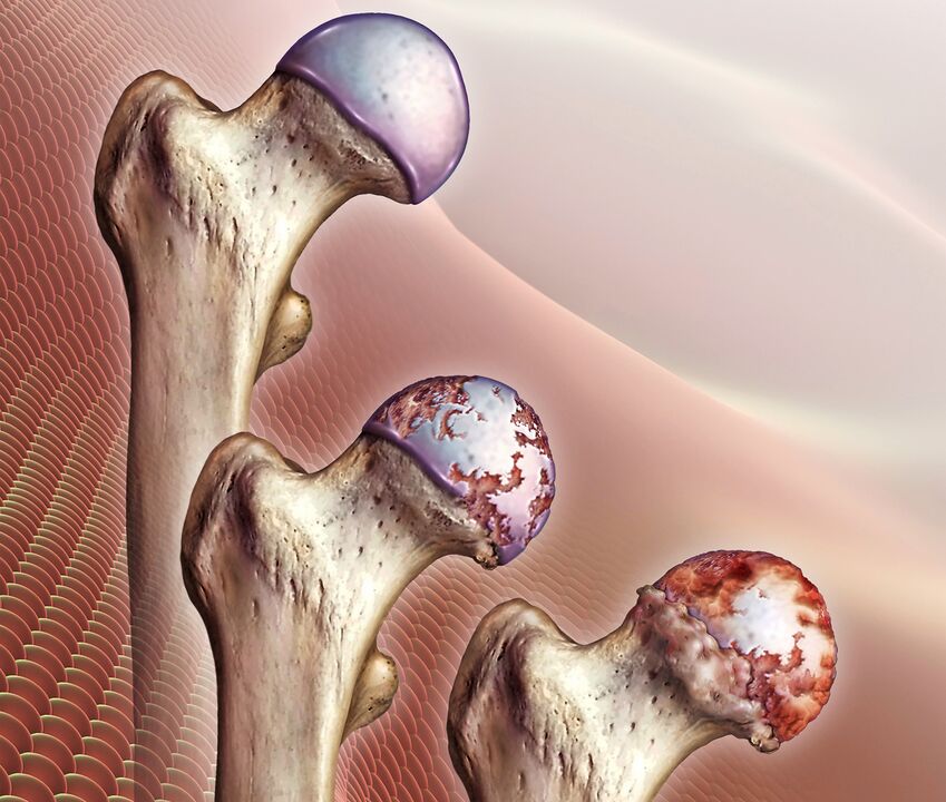 De ontwikkeling van artrose van het heupgewricht