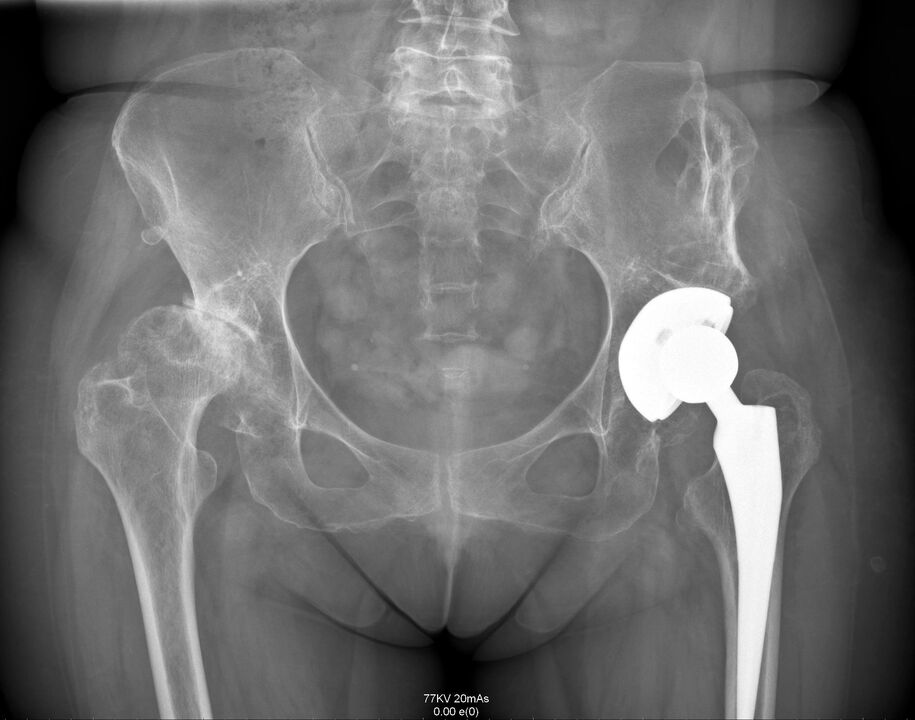 Röntgenfoto van het heupgewricht na artroplastiek