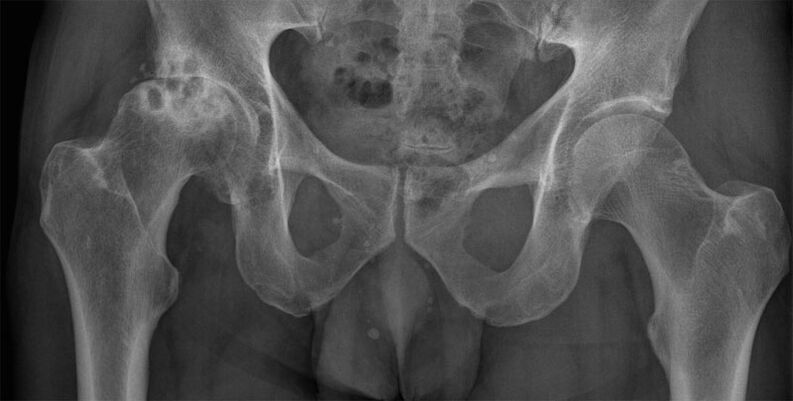 Vervormende artrose van heupgewricht op röntgenfoto