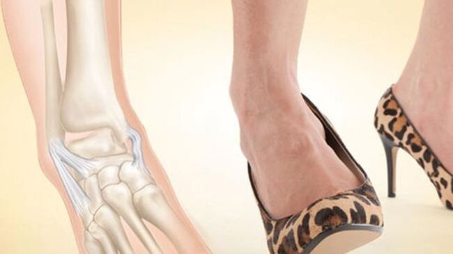 het dragen van schoenen met hakken als oorzaak van artrose van de enkel
