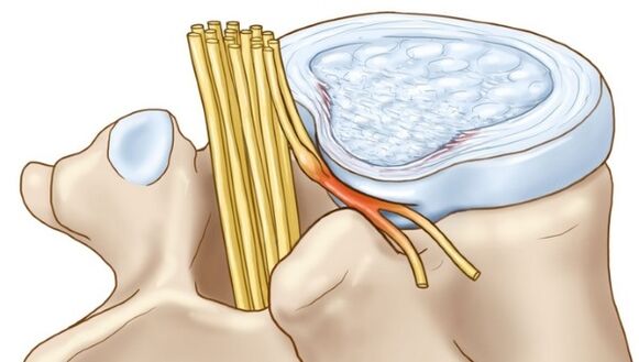 Lumbale osteochondrose kan leiden tot complicaties in de vorm van een hernia tussen de wervels