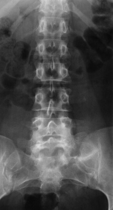Om lumbale osteochondrose te diagnosticeren, wordt radiografie uitgevoerd