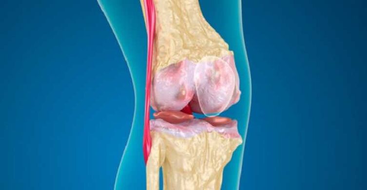 Arthrose van de kniegewrichtziekte, die de vernietiging van kraakbeen in de gewrichten veroorzaakt