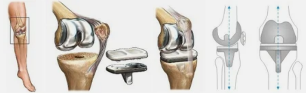 Endoprosthesis voor de knie, bijvoorbeeld